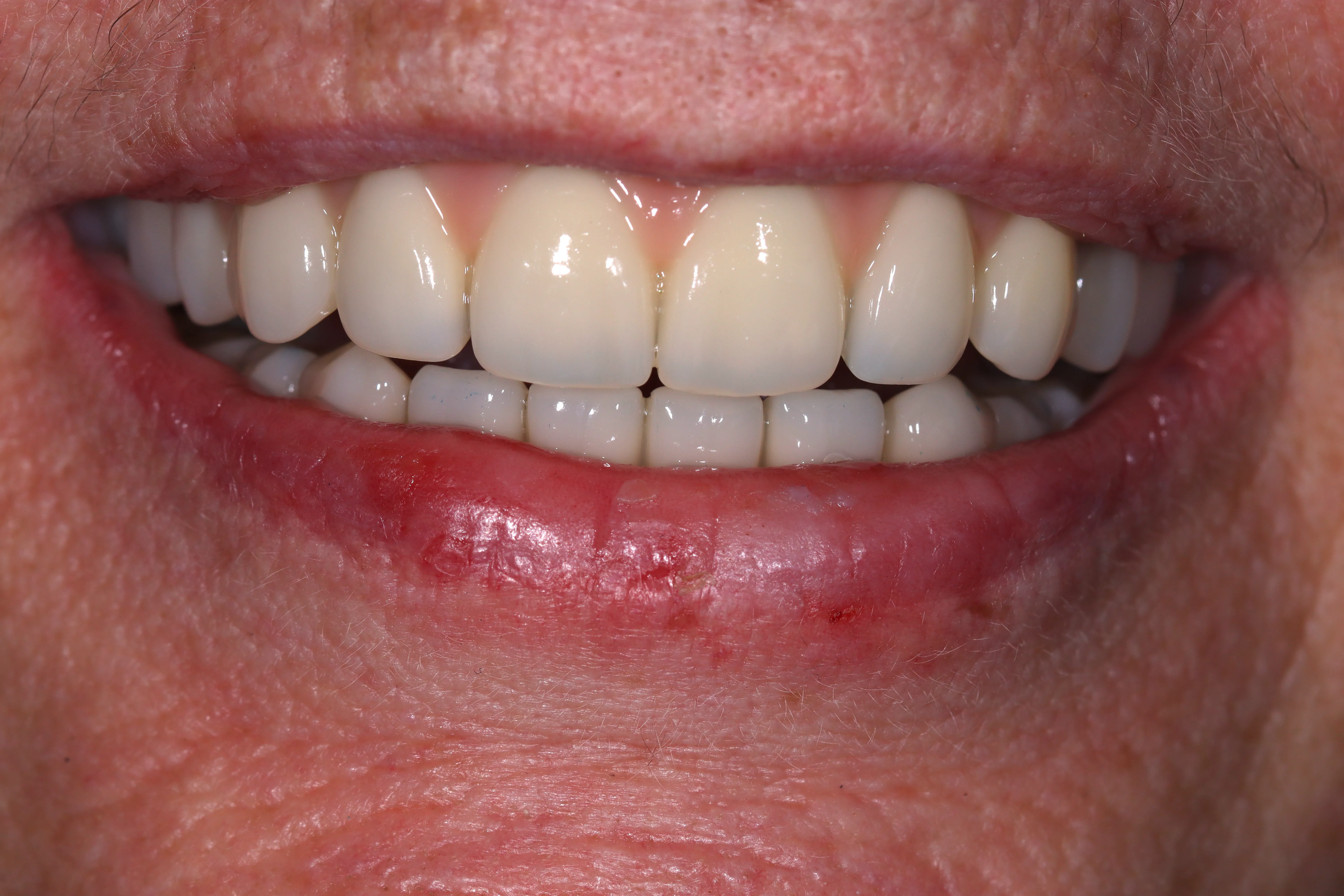 After Treatment