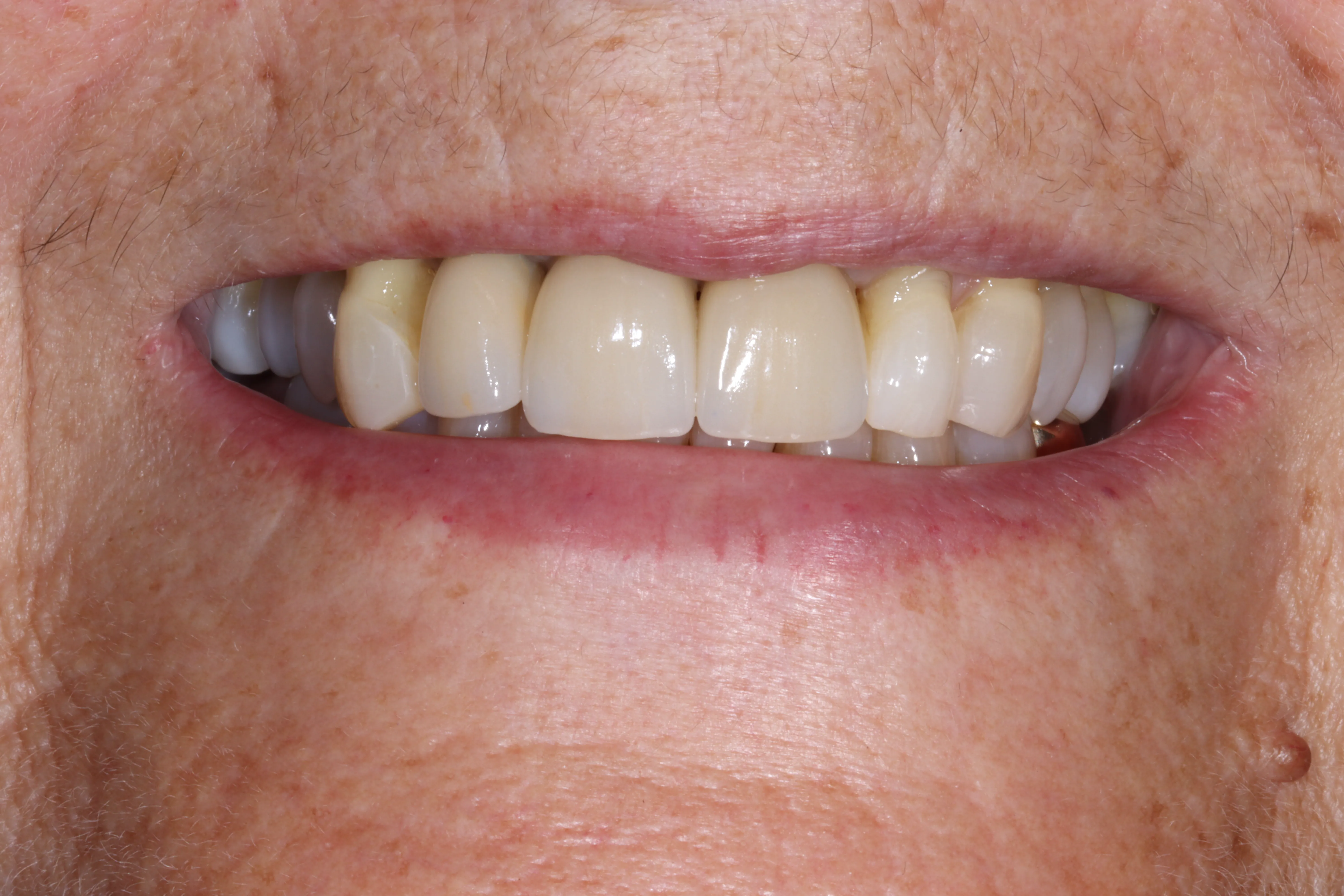 After Treatment