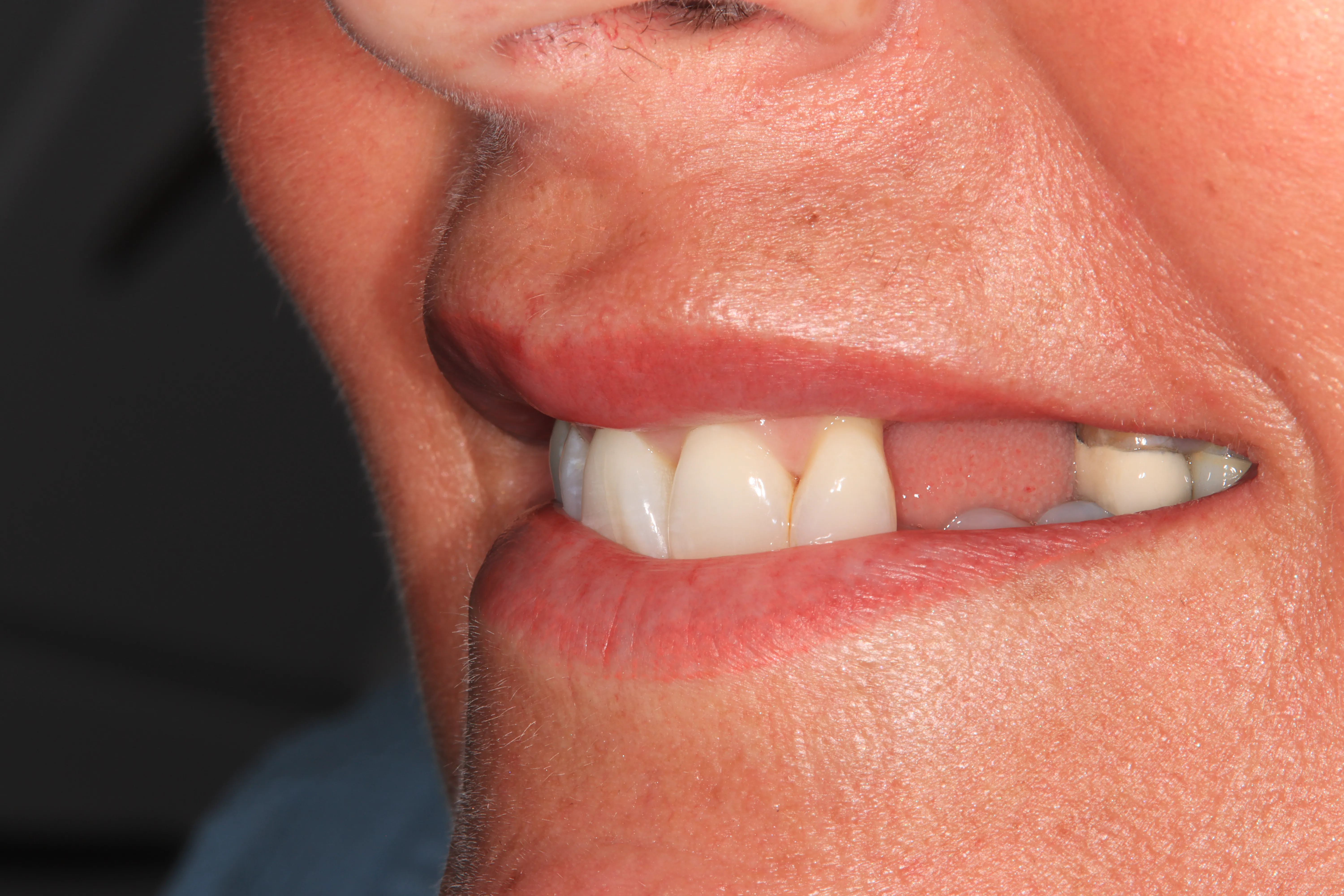 Before Treatment