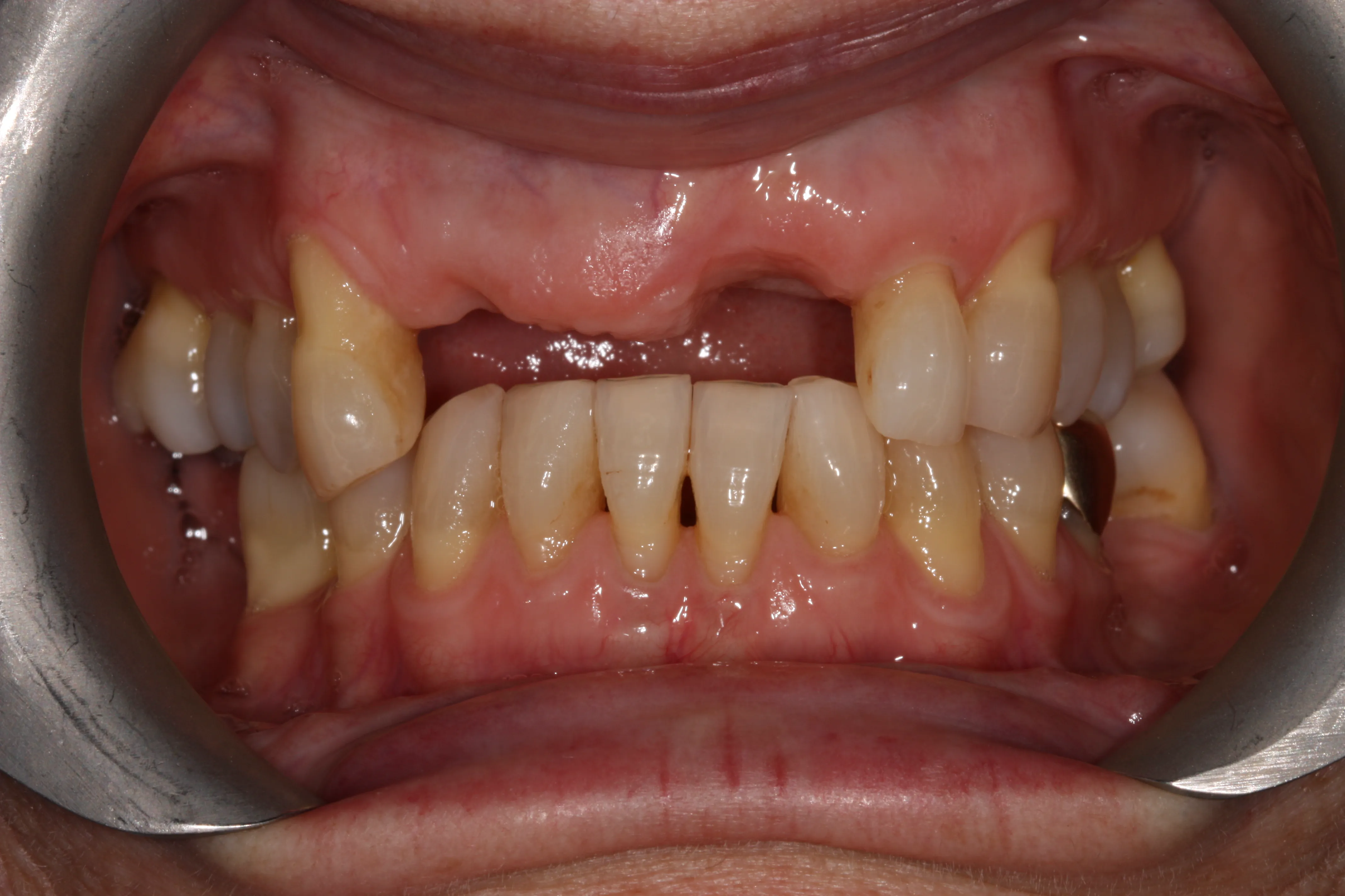Before Treatment