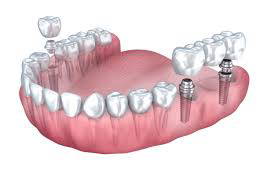 Multiple Tooth Implants