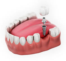 Single Implants